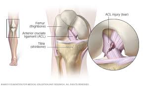 ACL Recovery